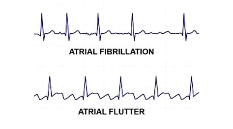 Flatter vs. Flutter .